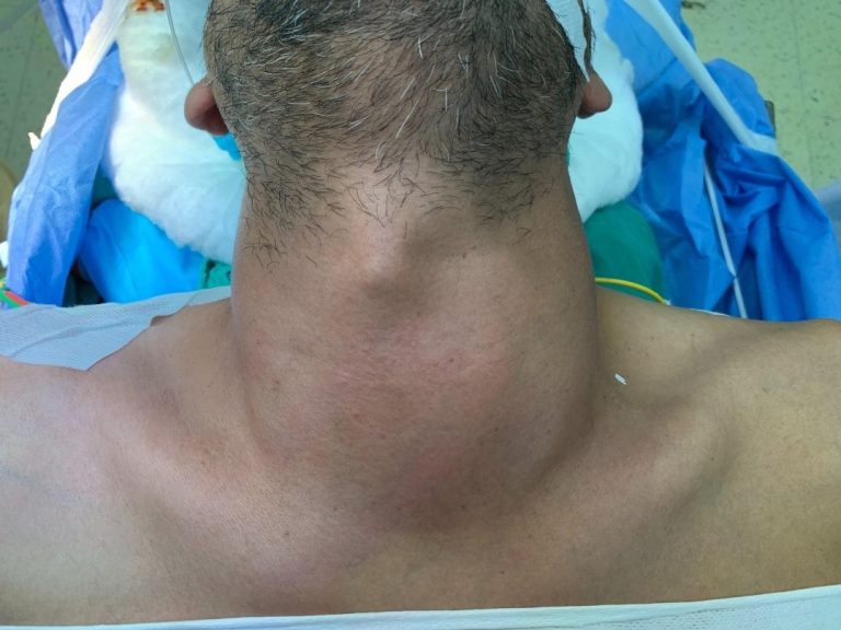 A 43 Year Old Mlp Admitted To Al Jalaa Hospital Following A 4 Month History Of A Neck Swelling 2269